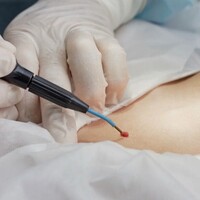 Электрохирургическая коагуляция и деструкция папиллом кожи от 2 до 5 мм до 5 штук без учета стоимости биопсии - alwento.ru – Екатеринбург