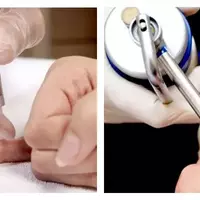 Криодеструкция бородавки, остроконечной кондилломы, контагиозного моллюска 1 штука до 2 мм в диаметре - alwento.ru – Екатеринбург